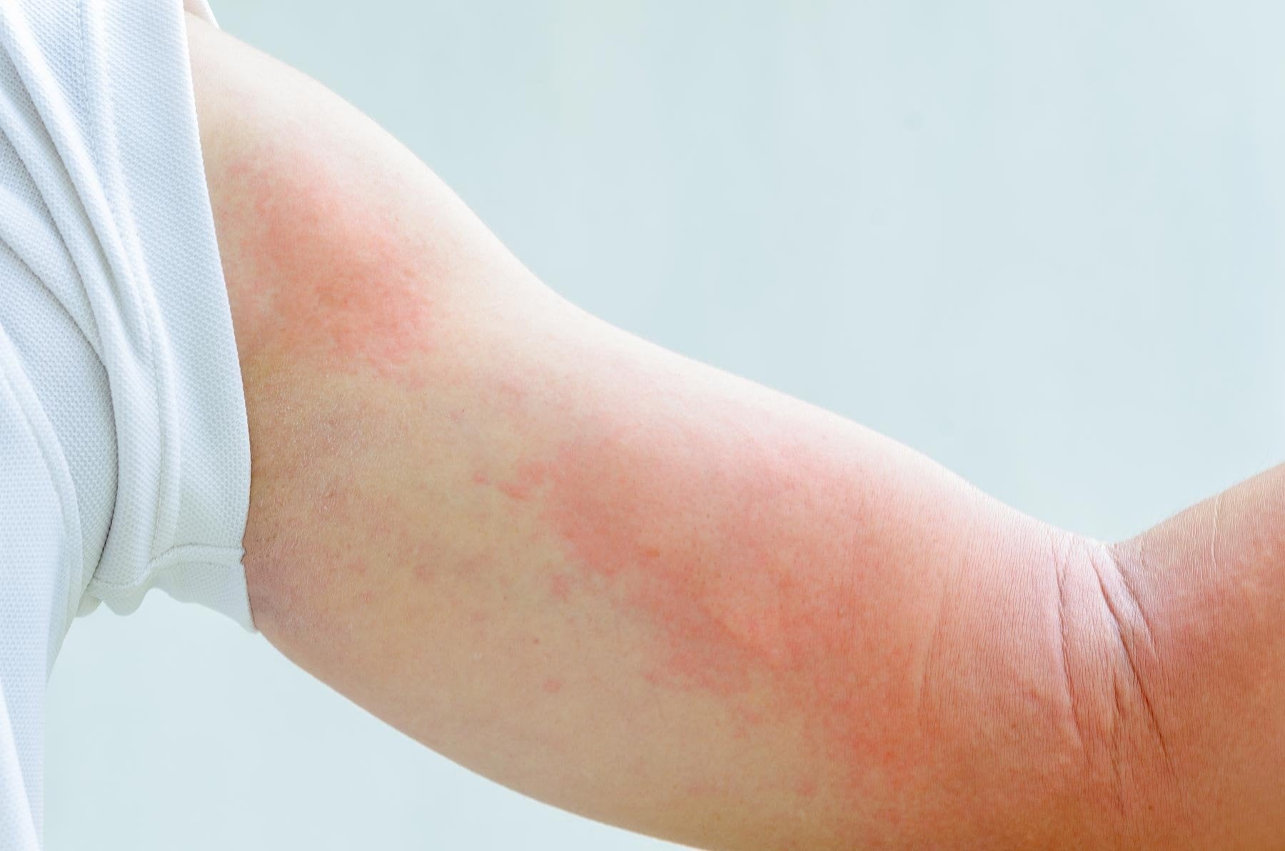 How to Identify and Treat Drug Rashes