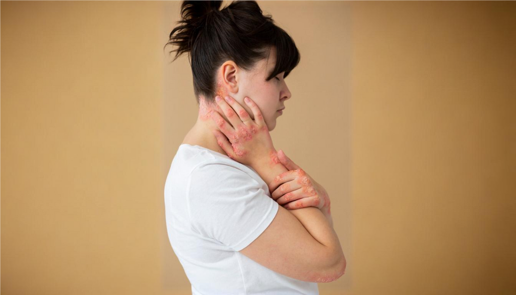 Types of Psoriasis