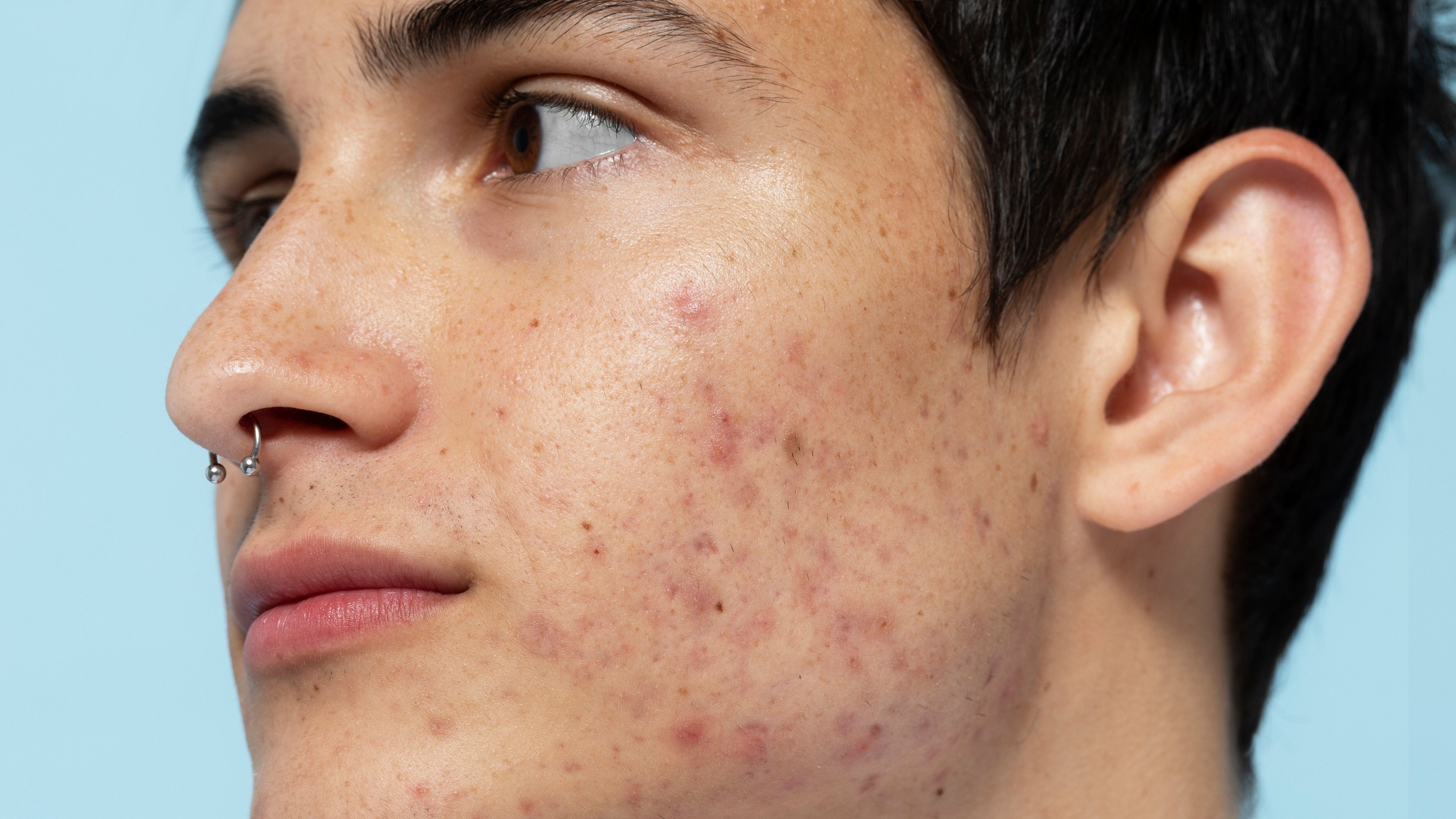 fungal acne vs bacterial acne