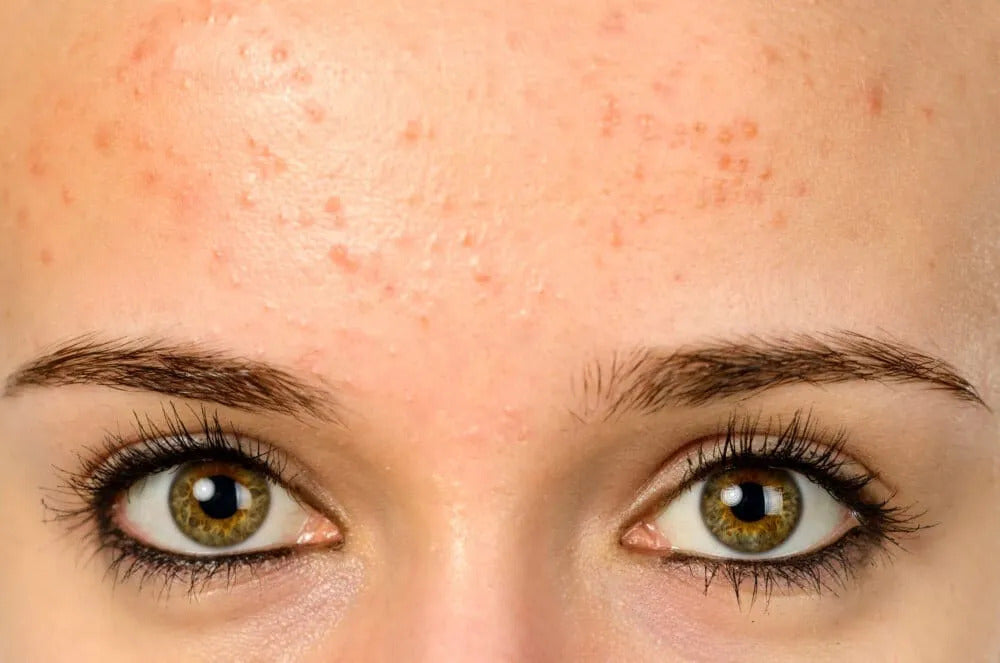 All You Need to Know About Fungal Acne
