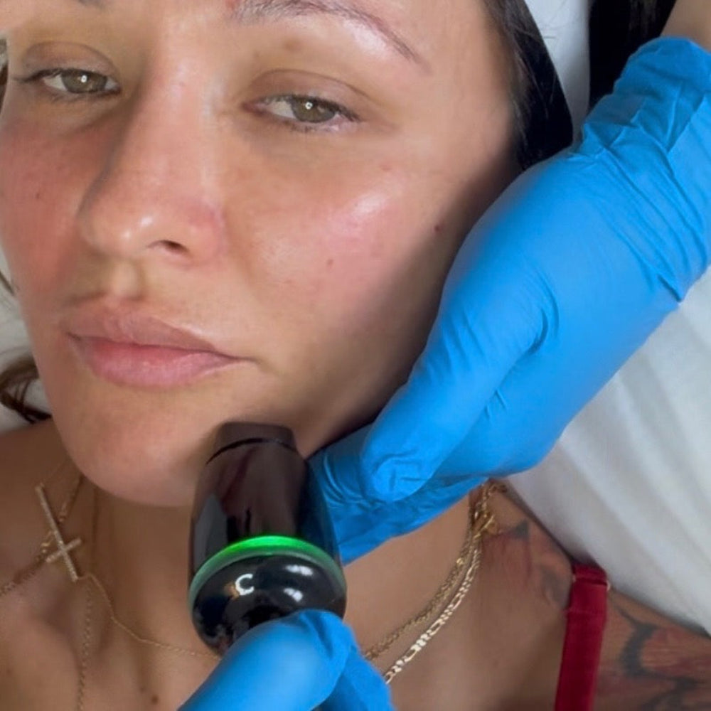 Hydrafacial, RF Microneedling, infusion of exosome booster