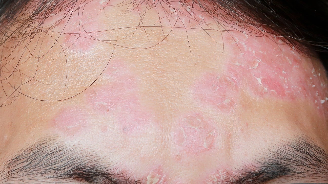 Premier Psoriasis Treatment in Malvern, Australia Premier Psoriasis Treatment in Malvern, Australia