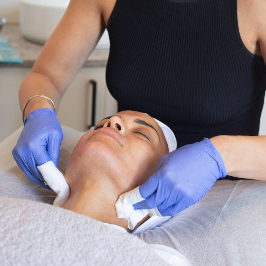 Woman receiving chemical peel treatment at a med spa