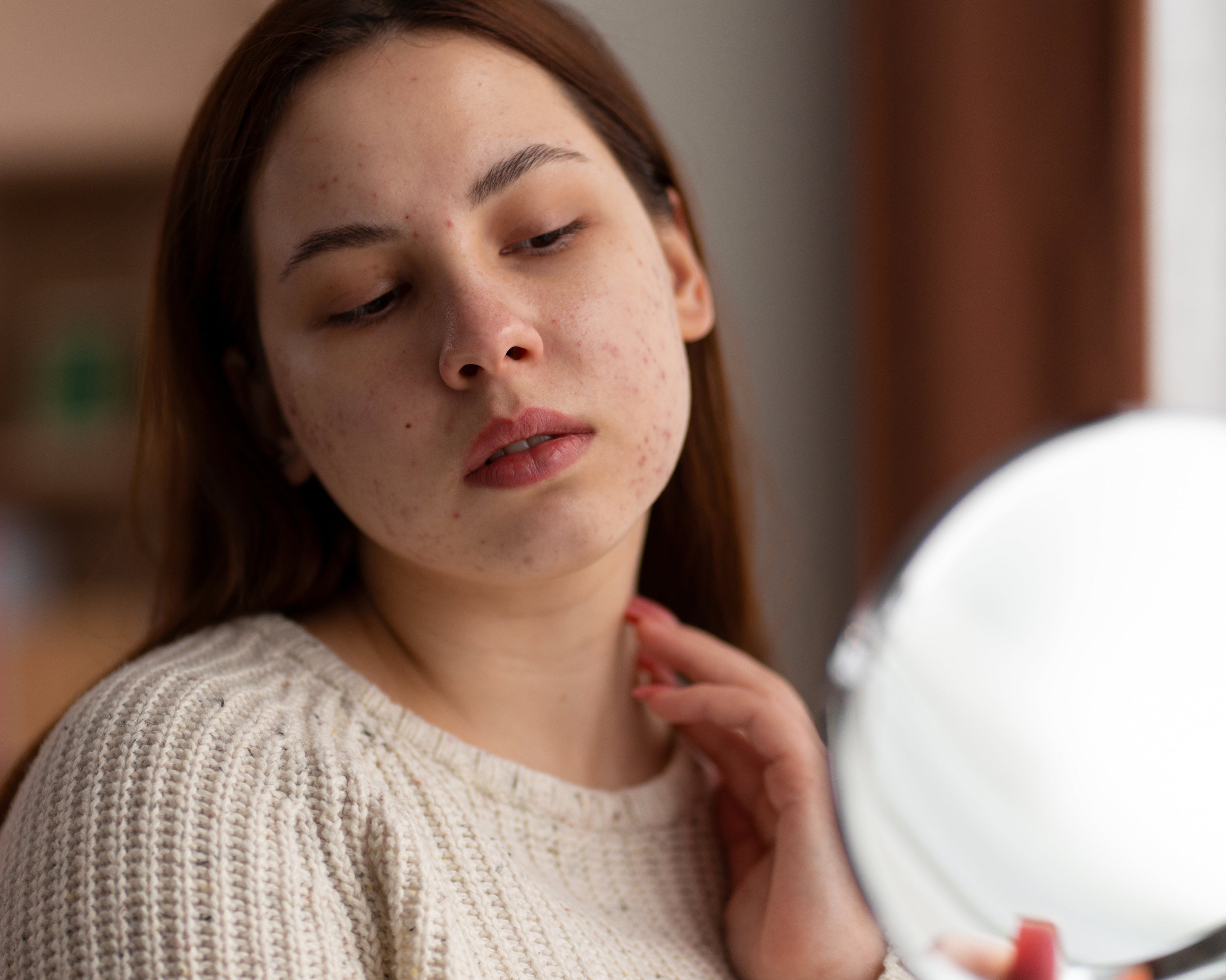 Acne Scar Prevention: 10 Effective Tips to Minimise Scarring