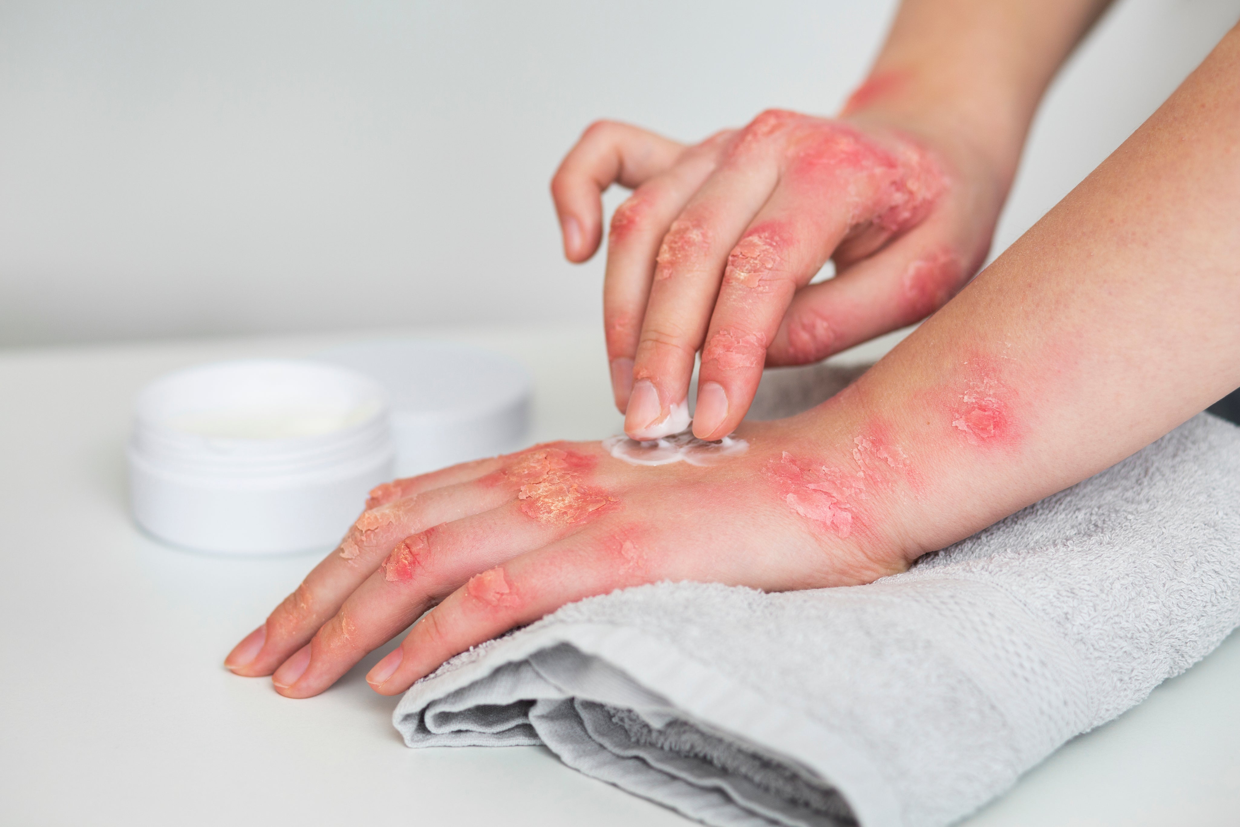 What Causes Eczema? Understanding the Triggers and How to Manage Them