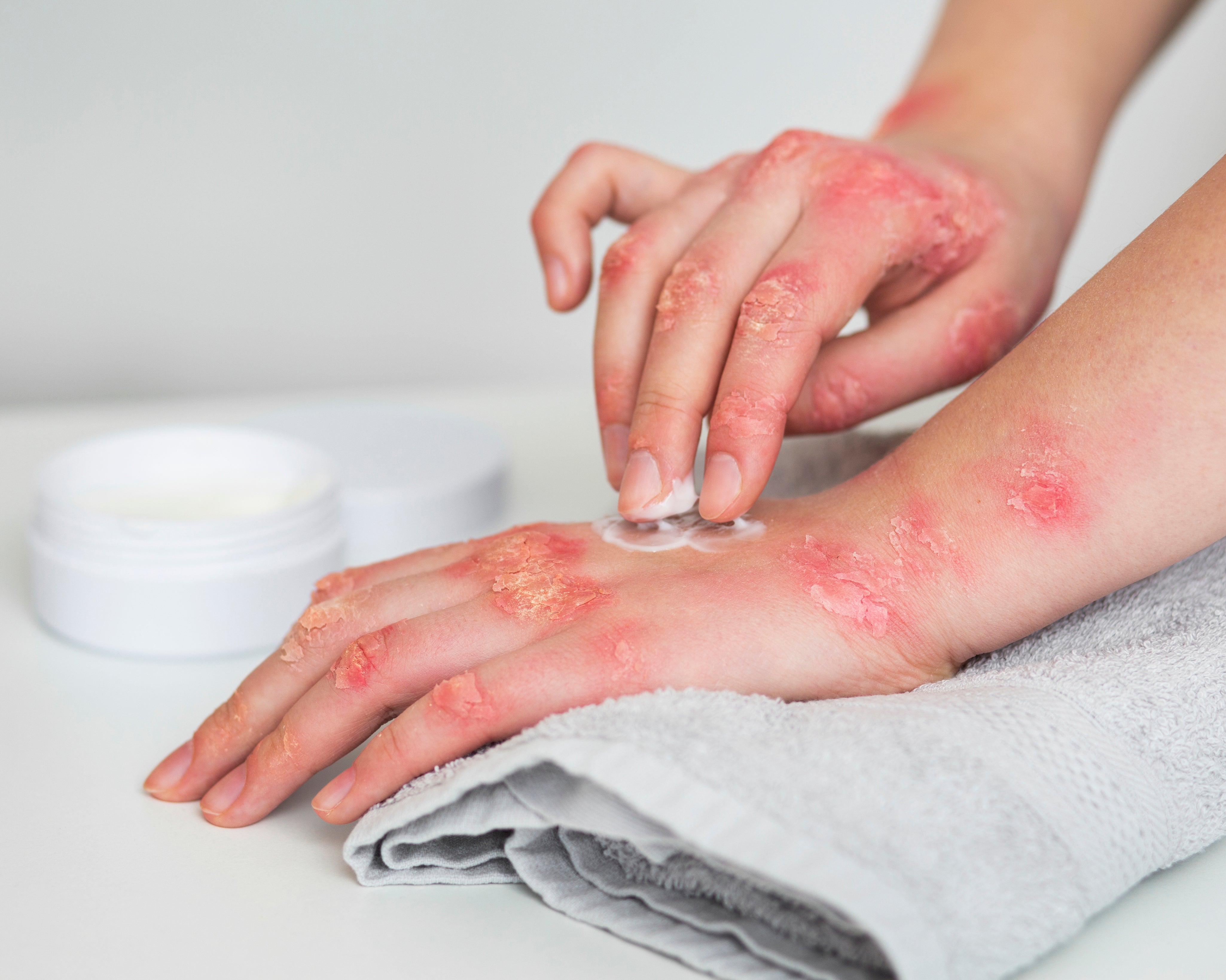 What Causes Eczema? Understanding the Triggers and How to Manage Them