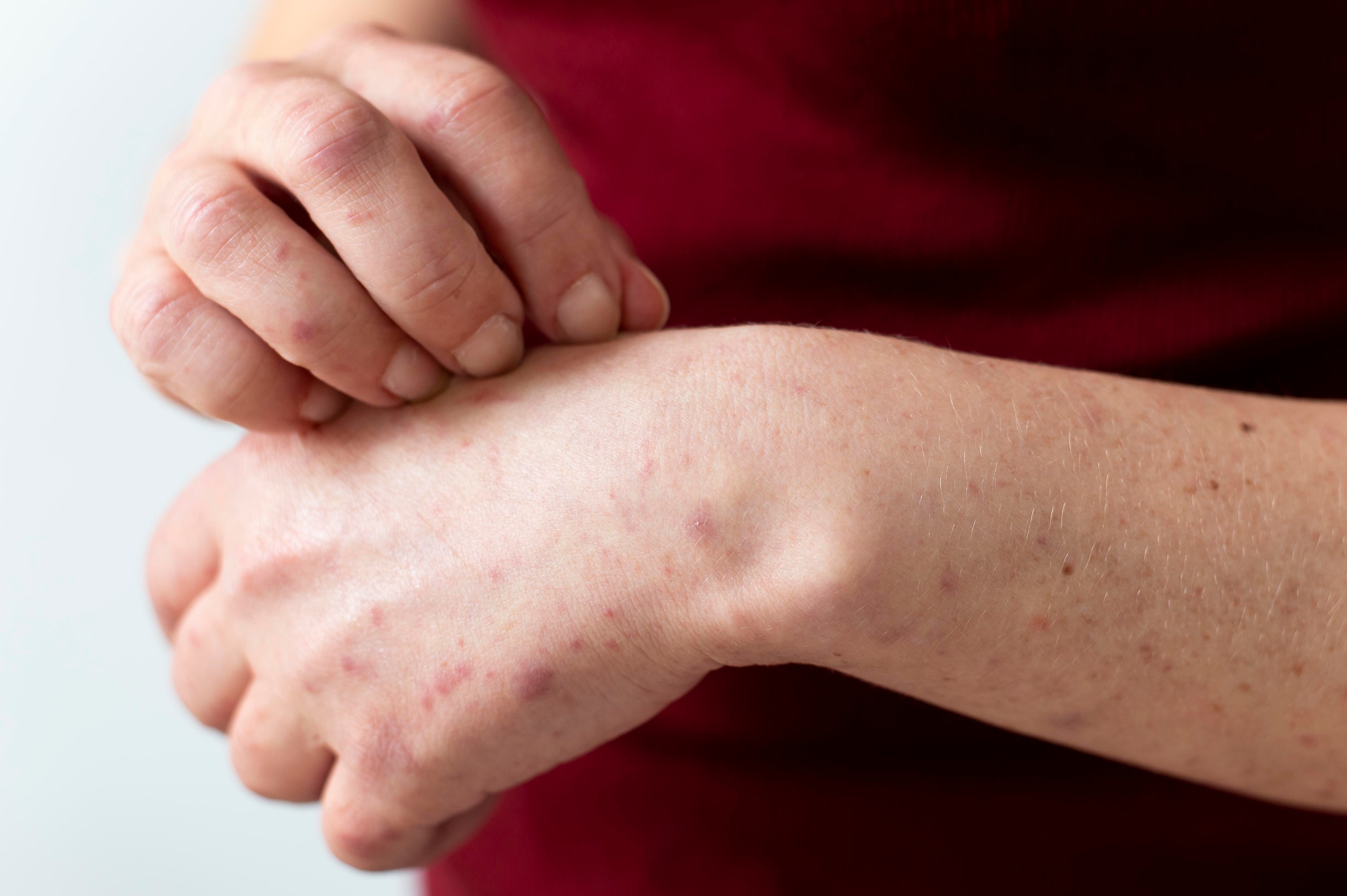 Common Triggers and Irritants of Sensitive Skin