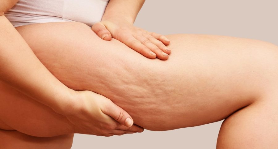 What is Cellulite? Causes, Treatments &amp; Expert Advice