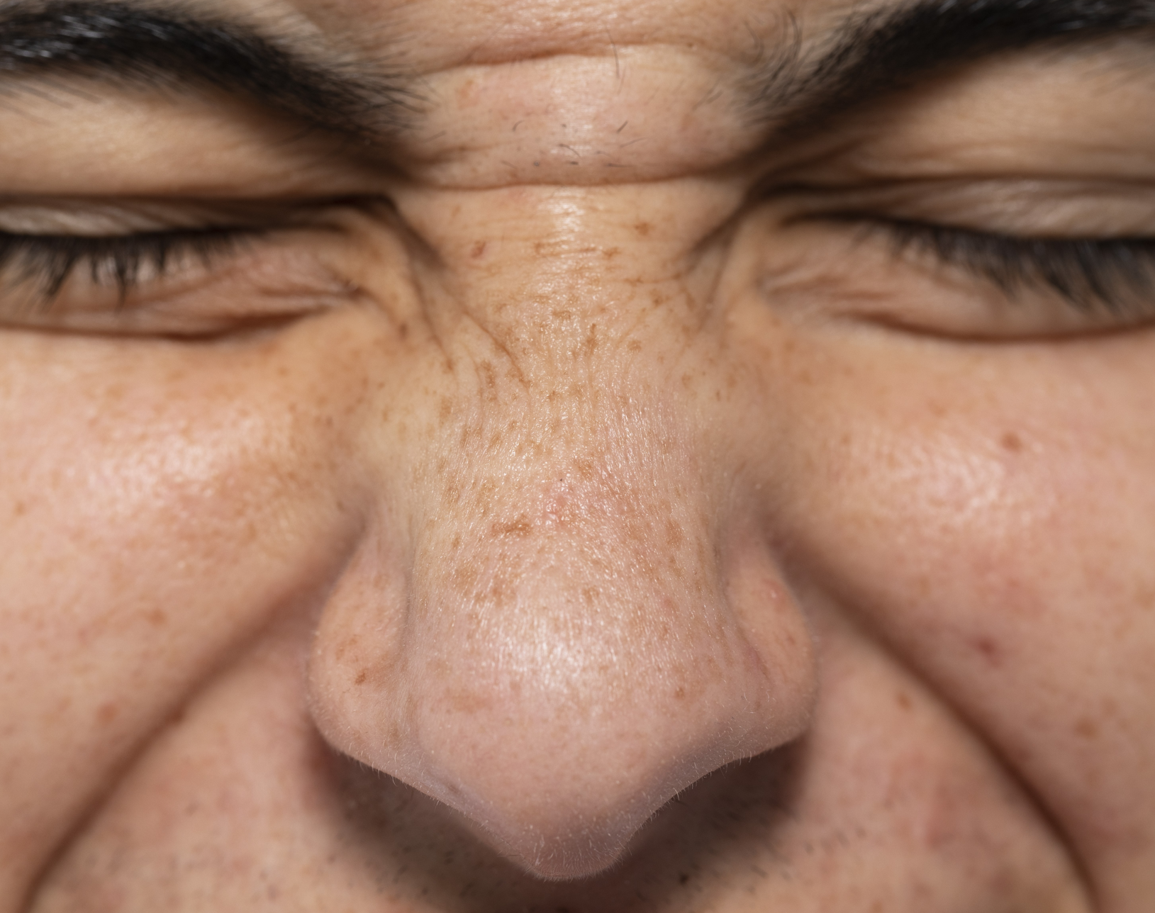 5 Reasons Why Your Pores Are Enlarged and What You Can Do About It