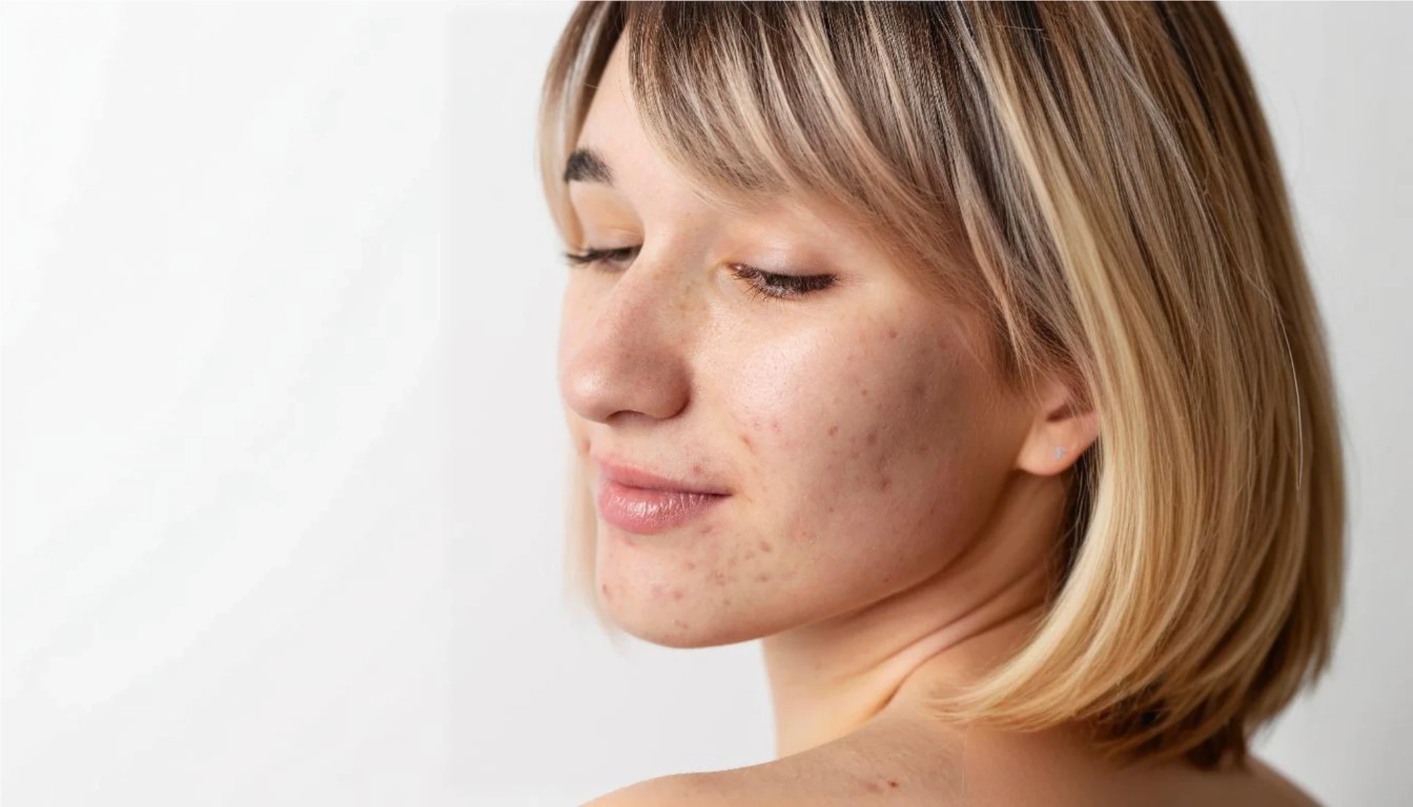 What is Post-Inflammatory Hyperpigmentation (PIH)