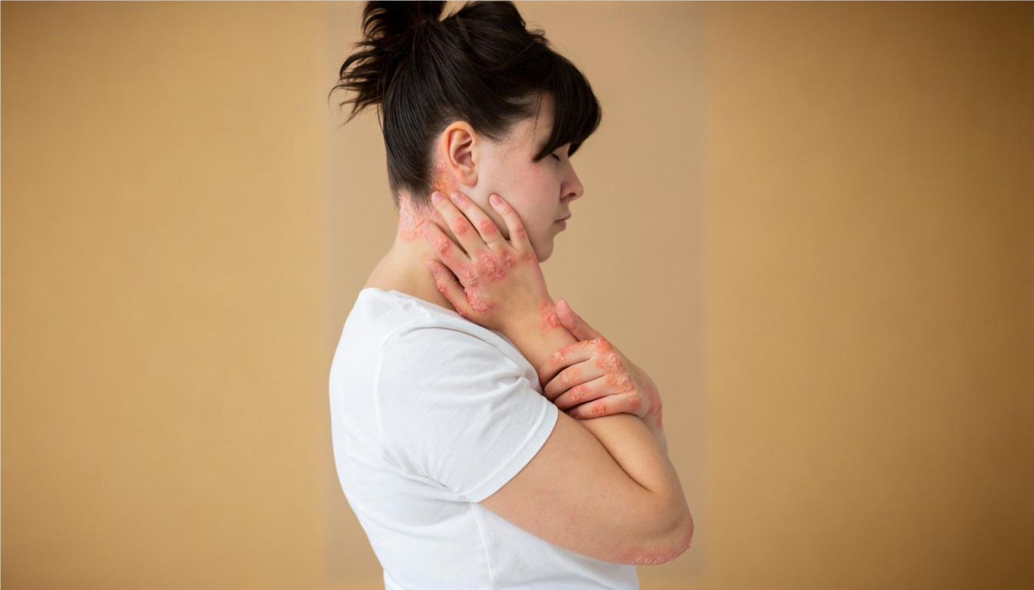 Types of Psoriasis