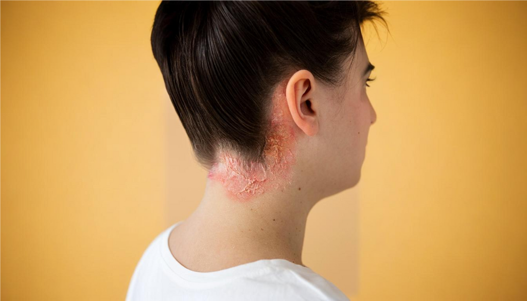 How to Treat Scalp Psoriasis