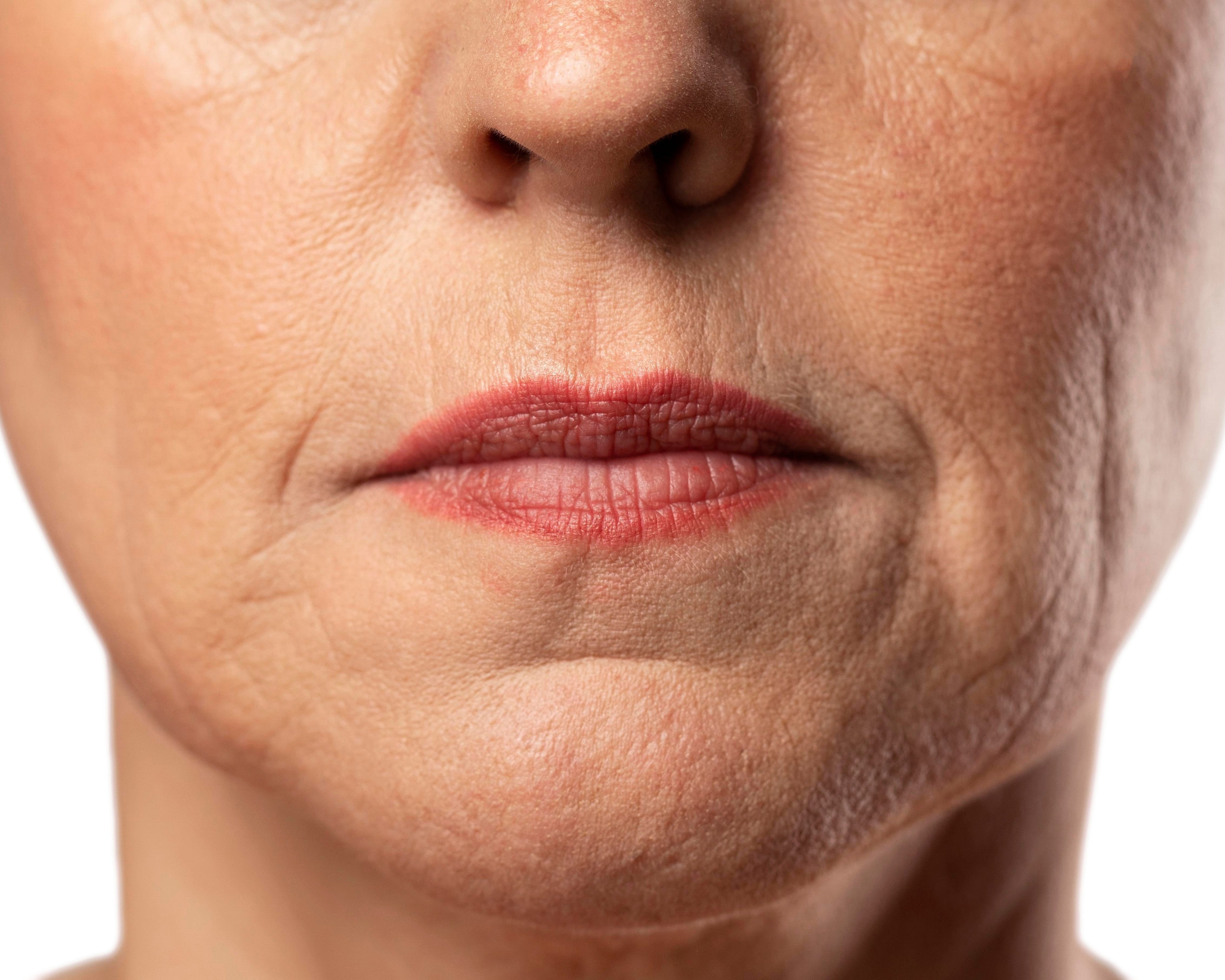 What Are Jowls and How Do You Treat Them?