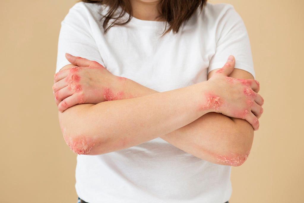 Natural Treatments for Eczema on Body
