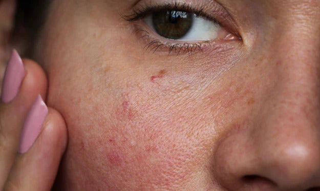 Over-exfoliated Skin? Here’s What to Look For and How to Fix It | Signs of Overexfoliated Skin