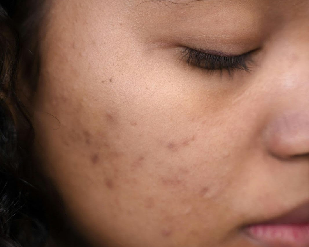 hyperpigmentation