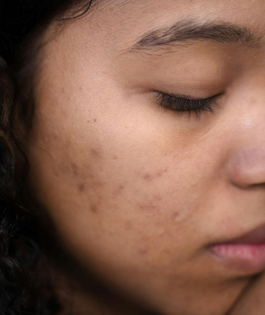 Hyperpigmentation 101: Types, Causes, and Treatment