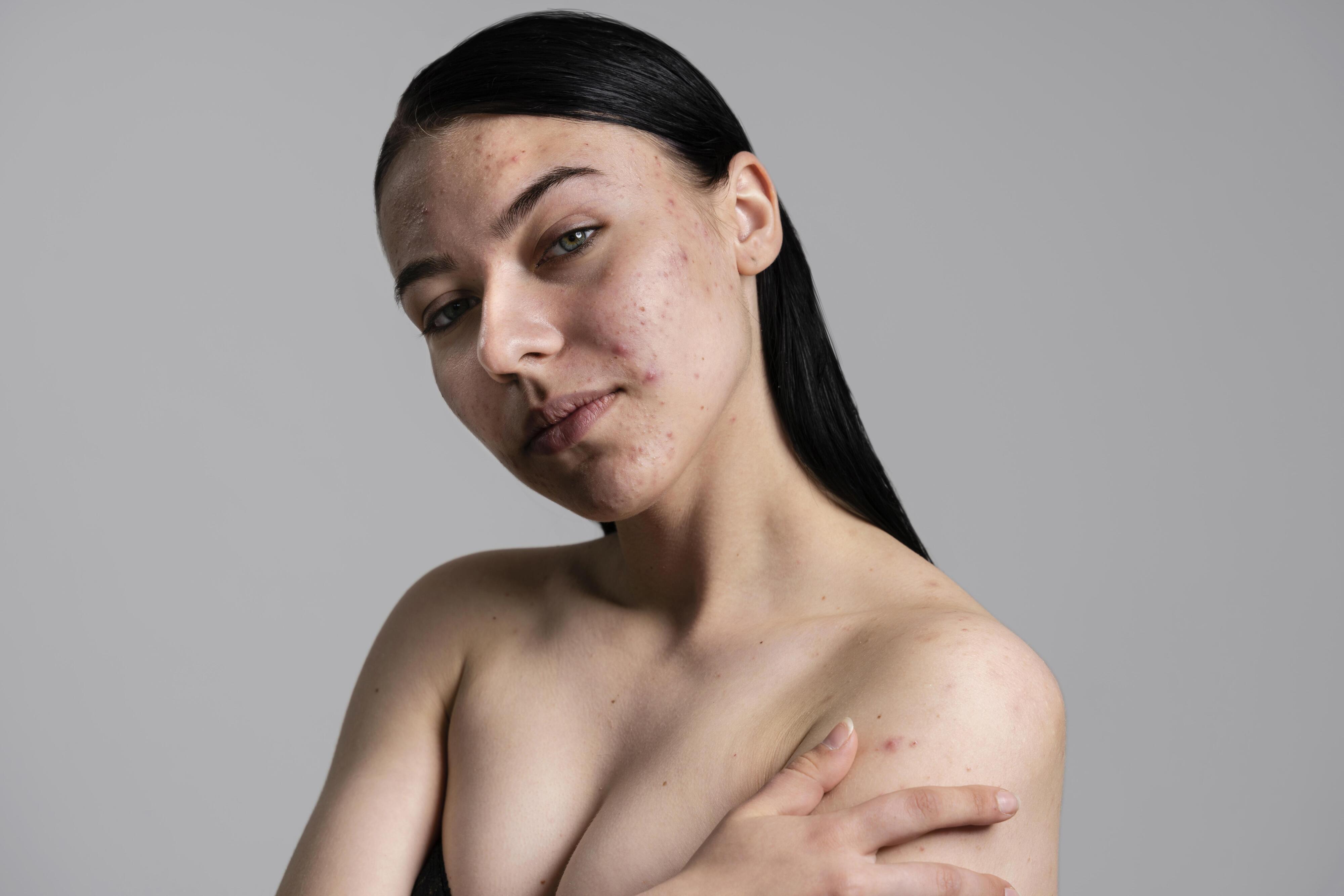 How Do Acne Scars Form and What Can You Do to Prevent Them?