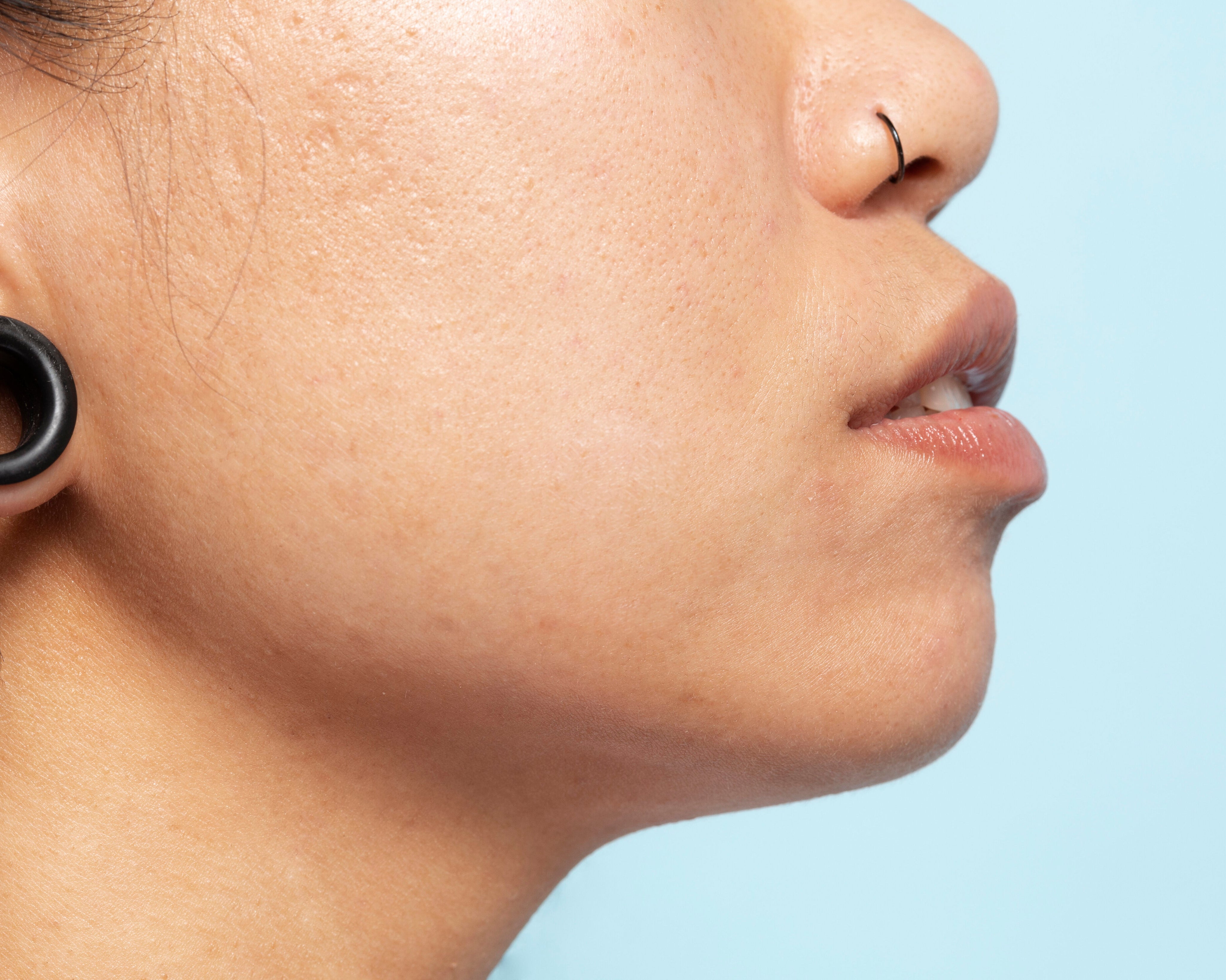 How Do Acne Scars Form and What Can You Do to Prevent Them?