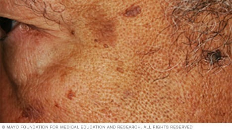 Sun Damage Pigmentation Treatment