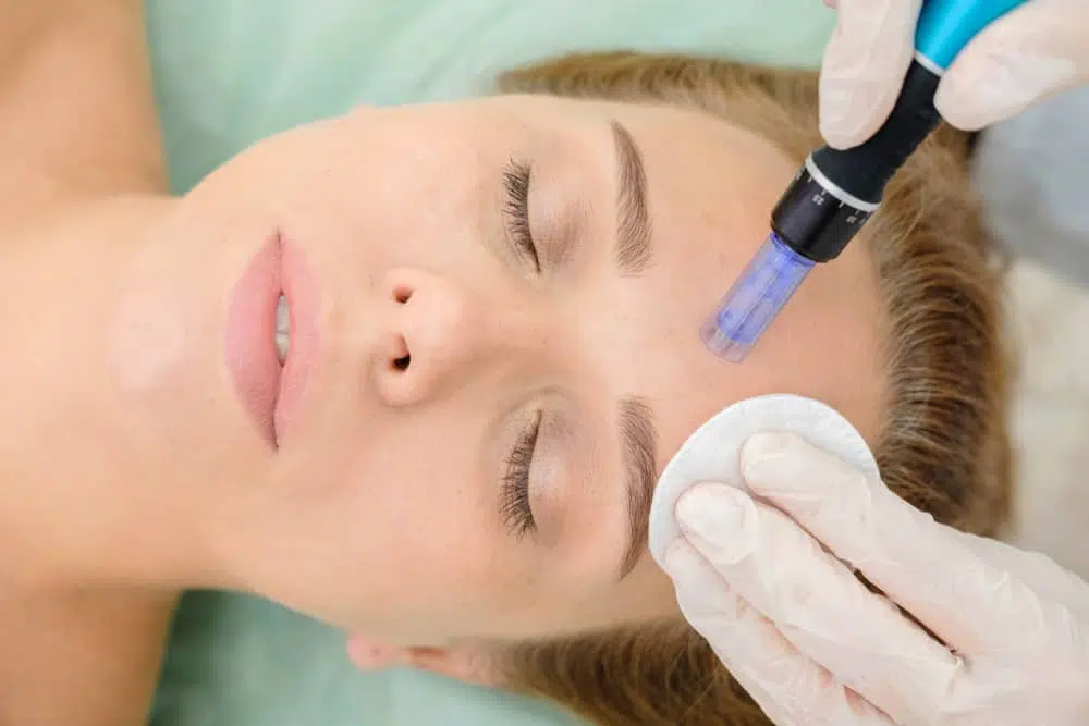 microneedling