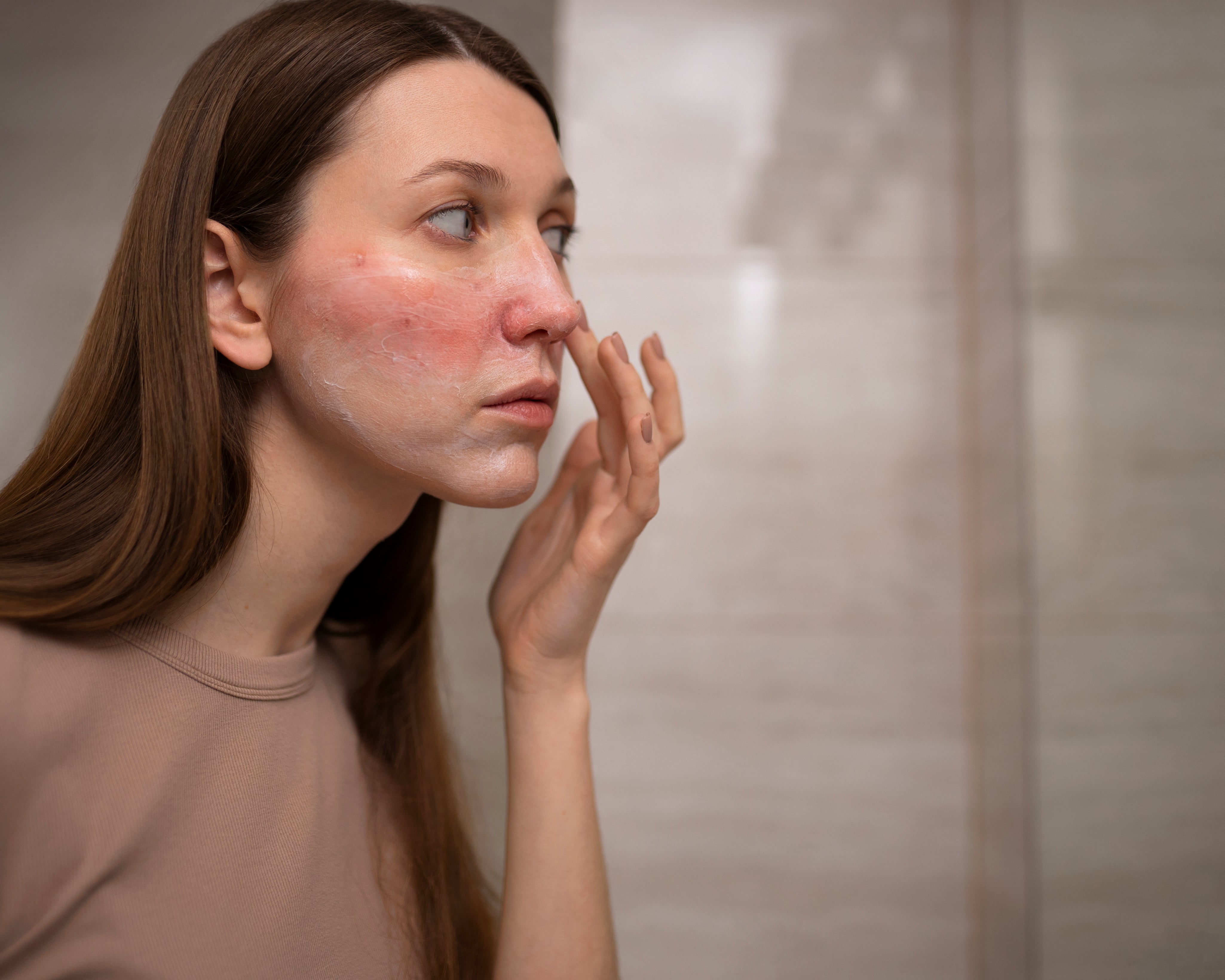 Common Rosacea Triggers