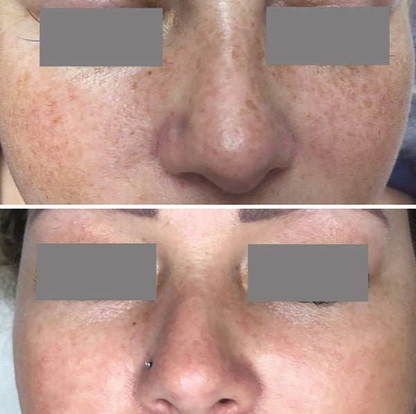 Frac Revive Advanced + Laser + Hydra Facial treatment before and after  | skintoheart