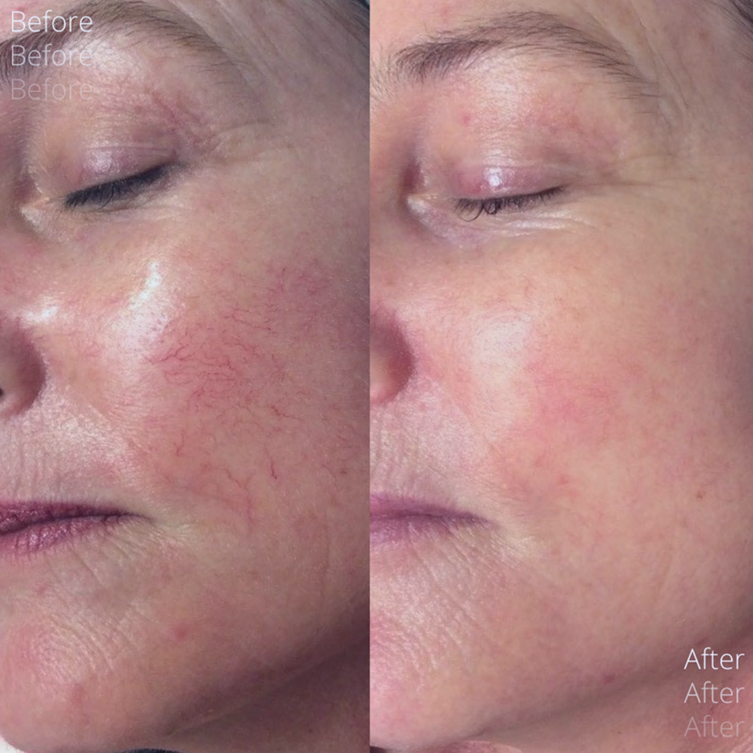 Frac Revive Advanced + Laser + HydraFacial treatment before and after  | Skin To Heart