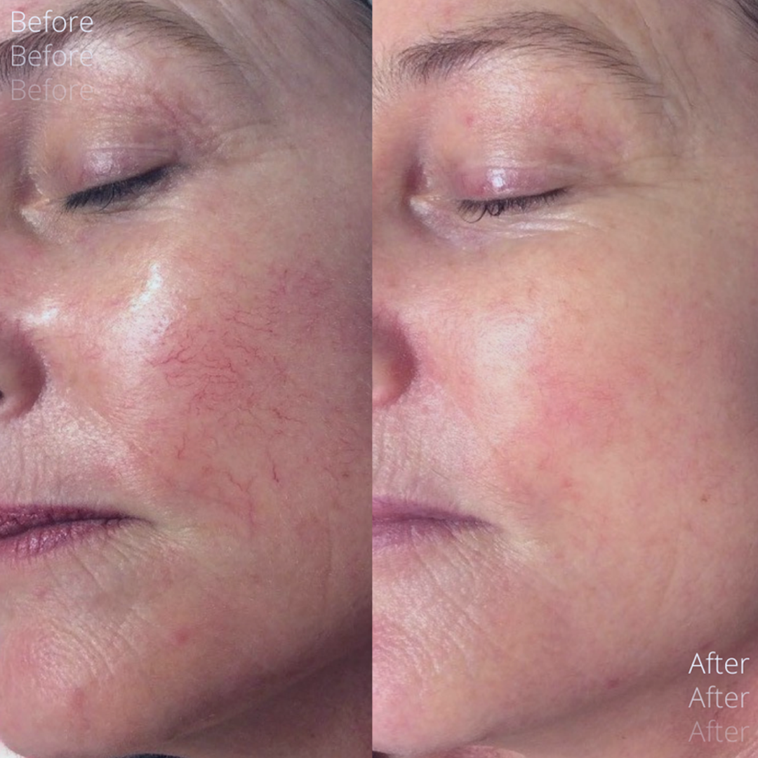 Frac Revive Advanced + Laser + Hydra Facial treatment before and after  | skintoheart