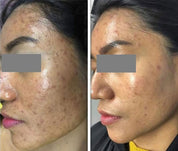 Frac Revive + HydraFacial before and after photos | skintoheart