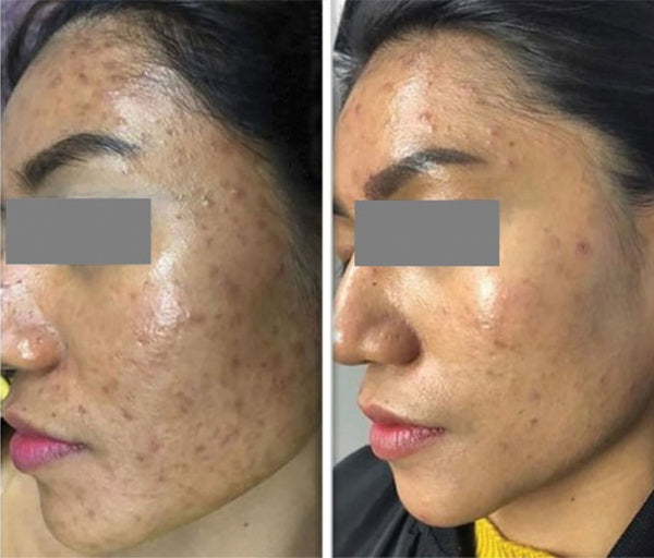 Frac Revive + HydraFacial before and after photos | skintoheart
